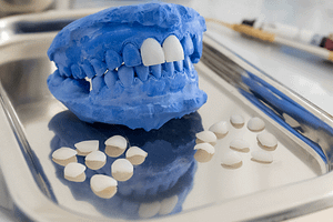 Dental veneers on a blue mouth model in the laboratory.