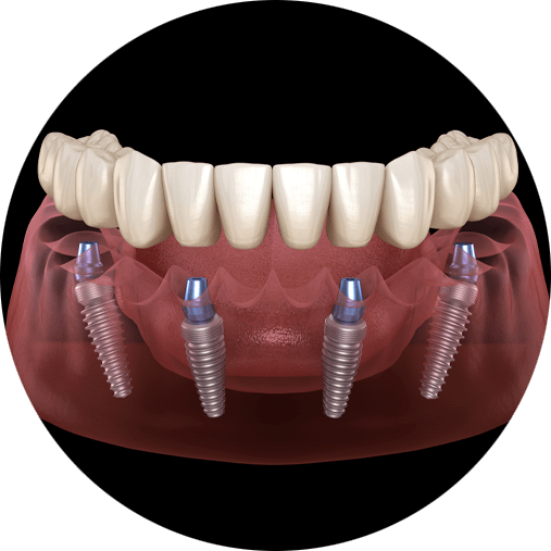 full arch dental implants