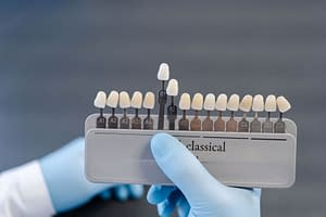 Dental technician holding a palette of tooth shade samples to match the color of dental implants or restorations, ensuring a natural and precise fit.