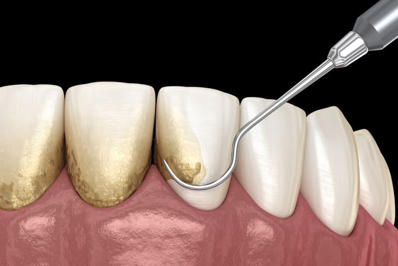 dental scaling and root planing