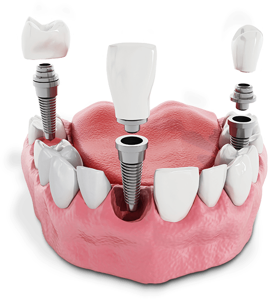 Multiple Dental Implants Above A Gumline