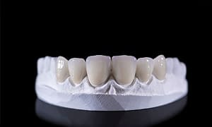 Dental veneers on a upper jaw model; laying on a black reflective table