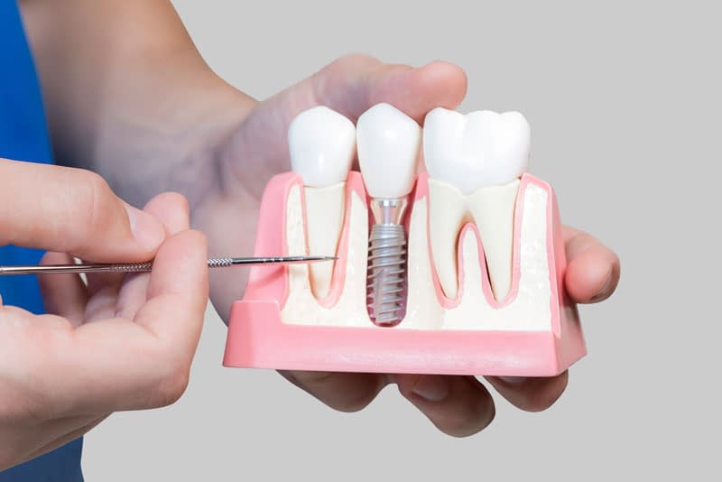 Dental Implant Model Cutaway